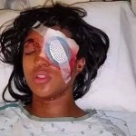 Woman lying in a hospital bed with a protective eye shield and bandages on her face.